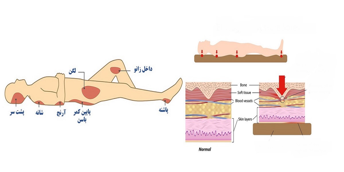 توسعه حسگرهای دیجیتال تنش برشی به منظور پیشگیری از زخم بستر